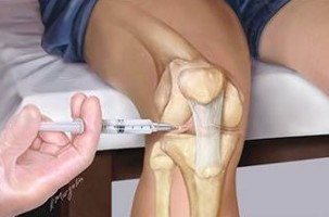 Инжекция гиалуроном
