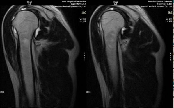 рентгенова снимка за диагностициране на артроза на рамото