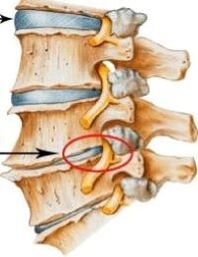 остеохондроза на шийните прешлени