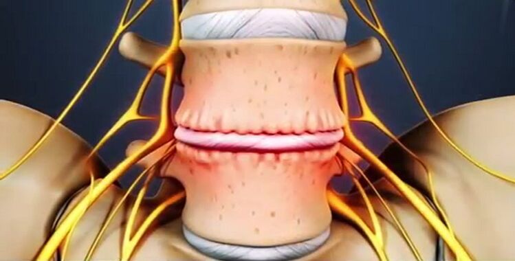 лезии на гръбначния стълб поради остеохондроза